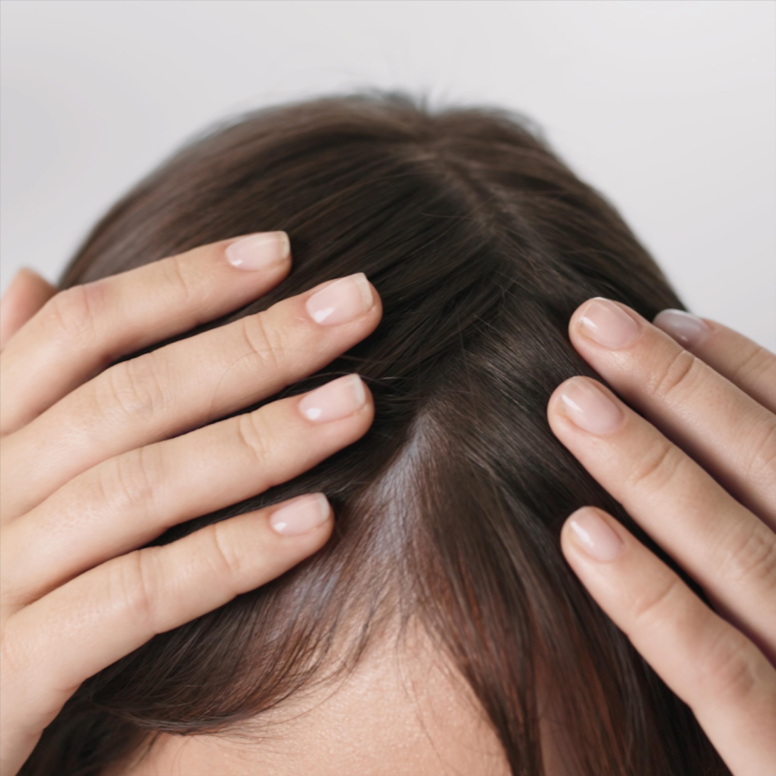 Sintomas e causas da alopecia difusa